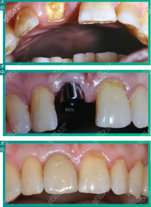 广州瑞德种植牙真人效果图
