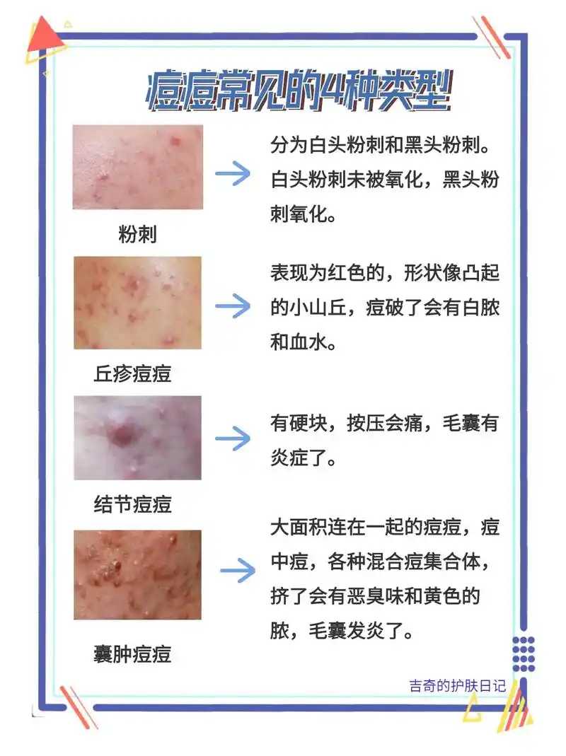 豆豆的4种类型,你知道自己是哪种类型吗?长逗是人生一大烦恼事 - 抖音