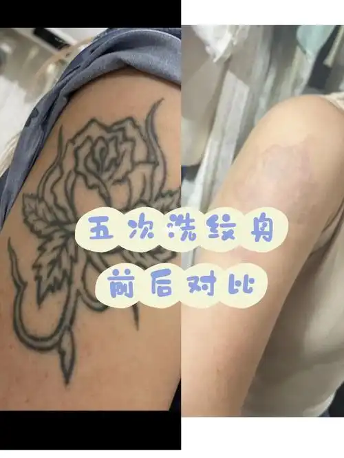 五次洗纹身对比