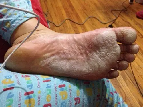 每天晚上回家脚掌脚发白,蜂窝眼,有臭味,但不是特别熏人那种,不过还是