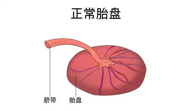 帆状胎盘是指脐带附着在胎膜上,脐血管在羊膜和绒毛膜之间通过,进入