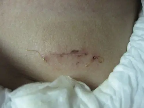 小儿一岁半,睾丸固定术后第八天,哪位大夫帮忙看看伤口情况