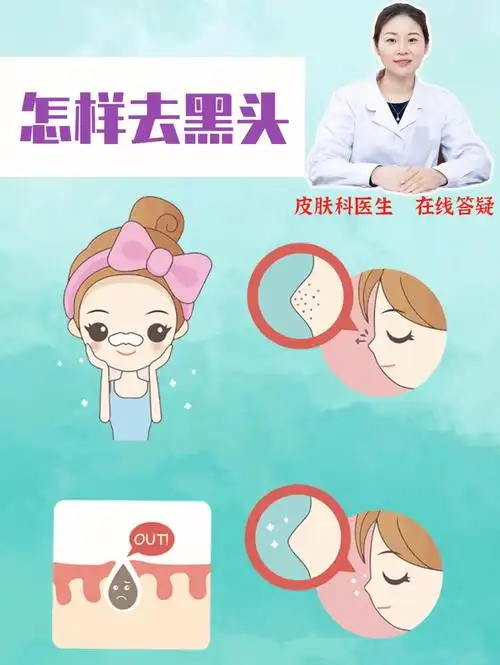 黑头正确处理姿势只需要3步