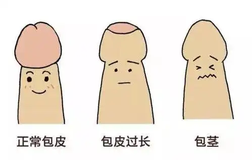 是,包皮紧紧 包住了尿道口,不能往上翻,丁丁完全无法露出,称为包茎