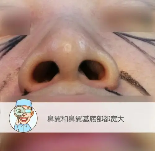 鼻翼太宽就要切除不一定具体要根据造成鼻翼肥大的原因来判断