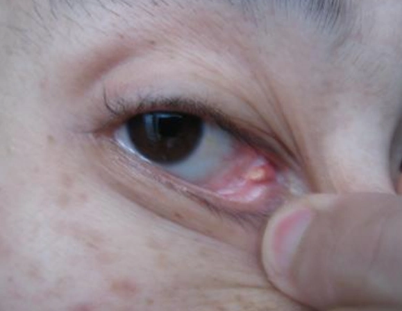 眼角长了个疙瘩图片 (16)_有来医生