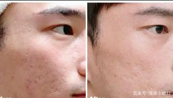 积雪昔霜钦育去痘印效果