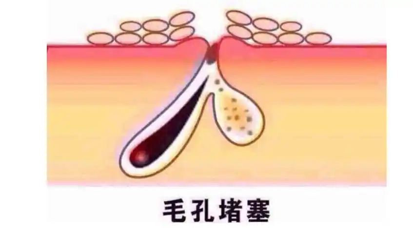 毛孔堵塞怎么办( 皮肤代谢不好毛孔堵塞怎么办 )