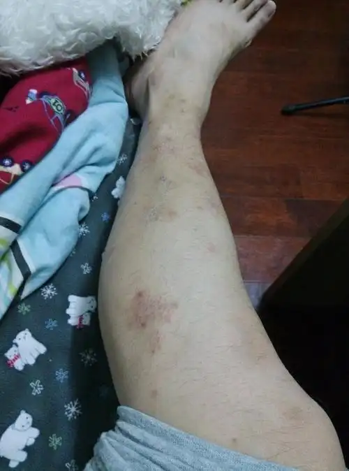 请教各位 这是腿上癣吗 两腿都有 好久了 快一年了 最近感觉超多了