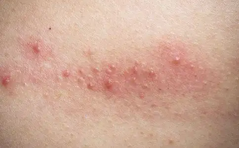 湿疹瘙痒难耐 重在养生护理 3个中医药方治疗湿疹简单又实用