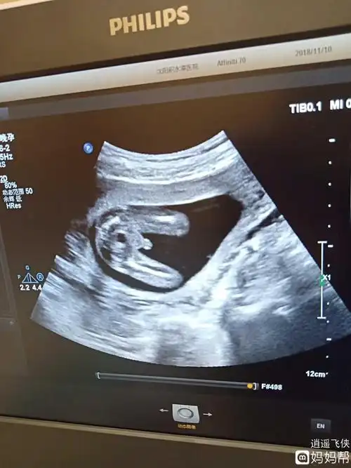女宝,长条形多为b超有两点基本是男孩看双顶径和股骨长双顶径减去股骨