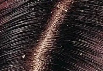 头屑多怎么办,快使用柔石无硅油植物洗发水