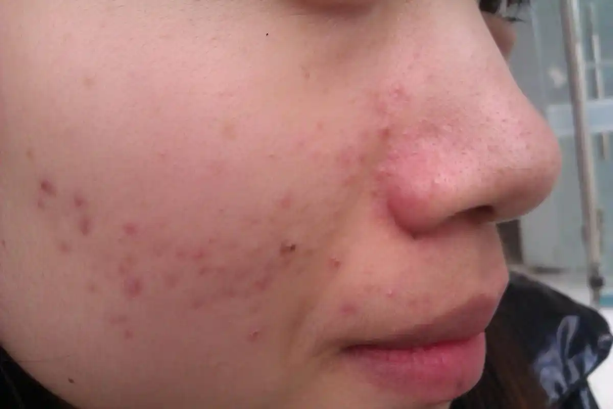 刚上大学一点都没长,大二开始长点,最近很是泛滥,痘痘感觉是长在皮肤