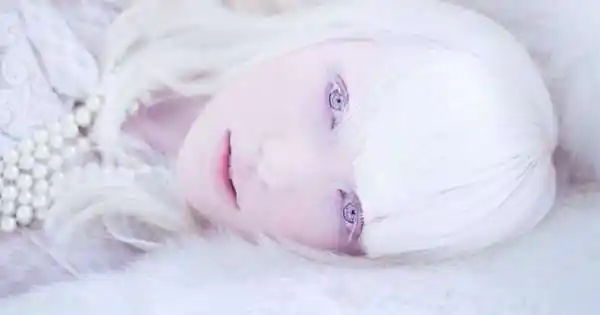 这名患有白化症的18岁俄罗斯女模以过人的勇气,让被