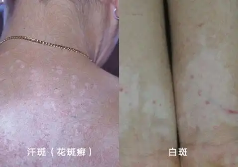 汗斑和白斑的区别对比图片