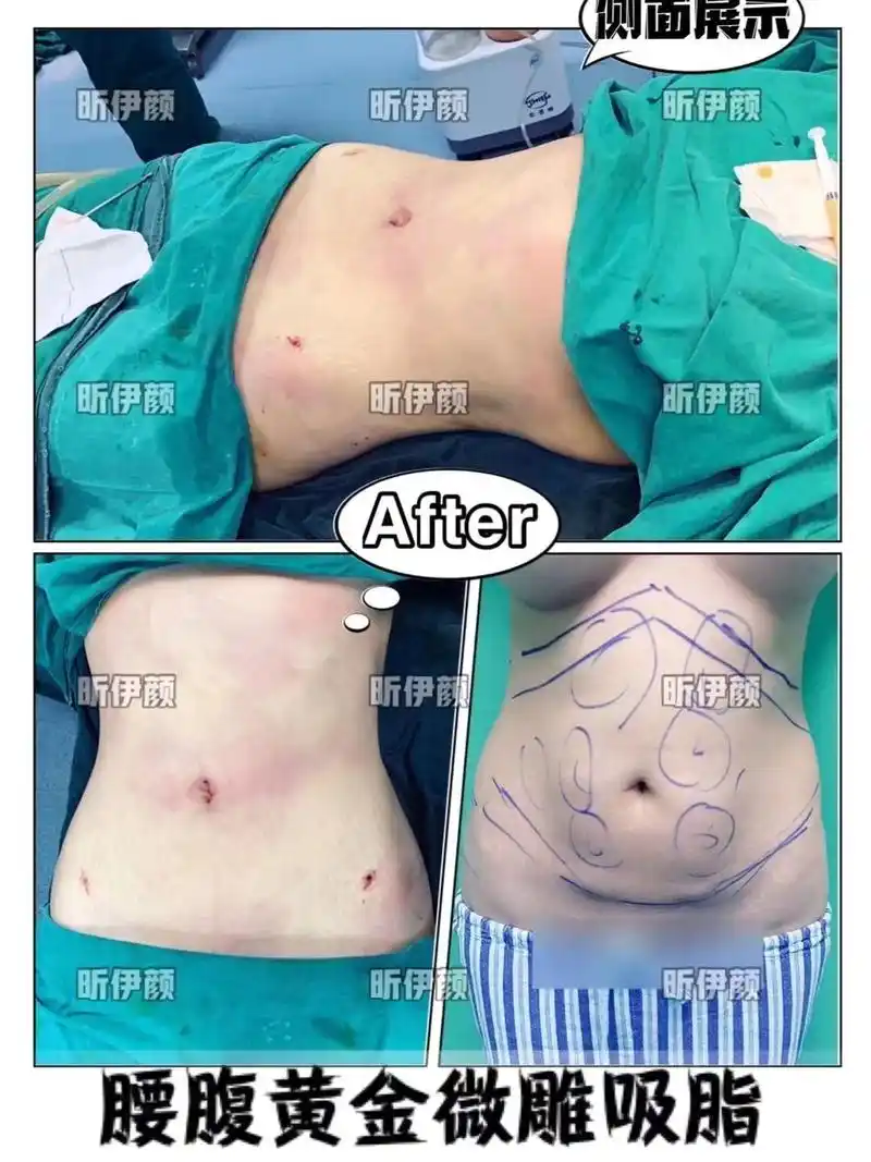 95腰腹环吸术后即刻78 缩小腰围直径0299雕塑脂肪91