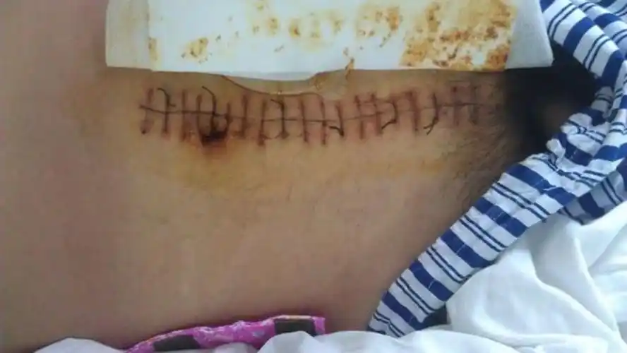 腹腔镜手术直肠癌中期图片