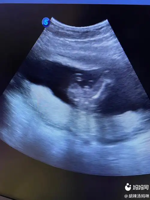 嘿嘿,18周,这个图有人能看出来男女吗?