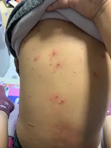 我母亲后背起了很多这样的小包,去医院医生看了说是过敏,但越来越严重