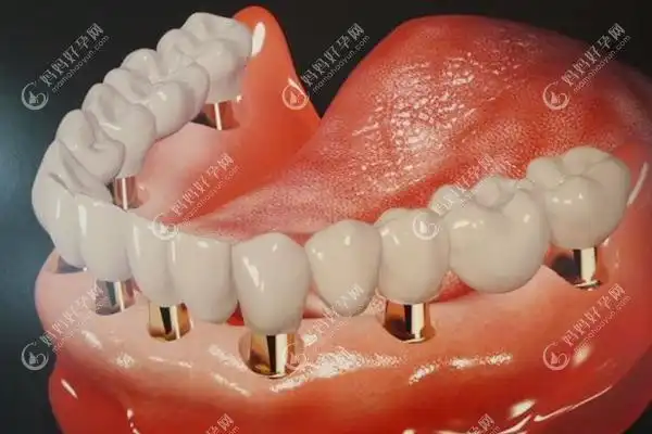 半口普通种植牙的图片