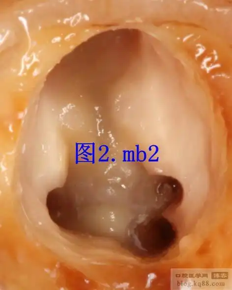 有关上颌第一磨牙mb2的疑问