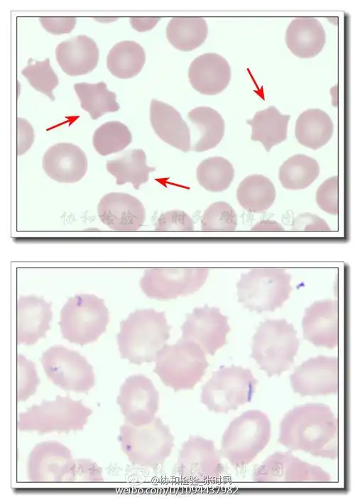 经验谈# 棘形红细胞(acanthocyte):红细胞.