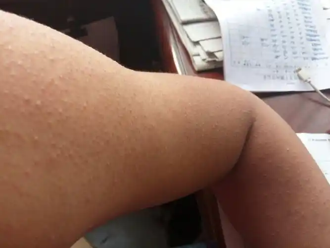 您好,我胳膊上有许多小疙瘩,不疼也不痒,以前问过医生说,毛孔