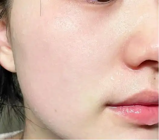 女生敏感肌护肤脸上容易长红血丝干痒刺痛起皮敏感肌肤如何正确护肤