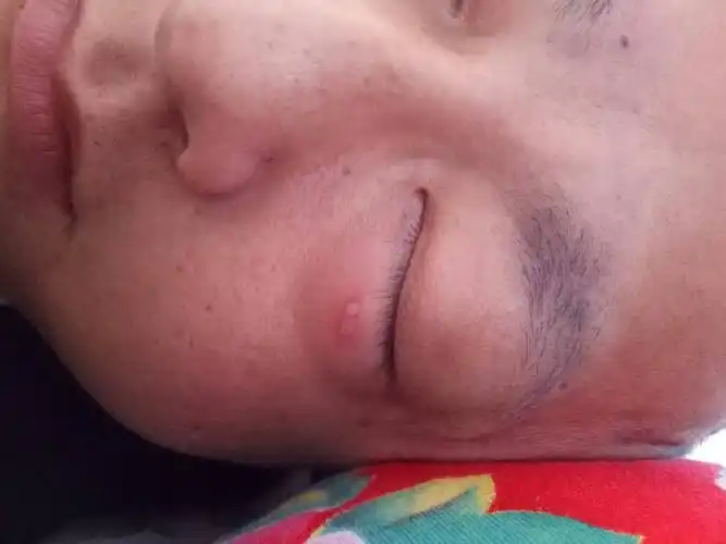 采干后眼睛下面涨了个水泡是苞疹吗