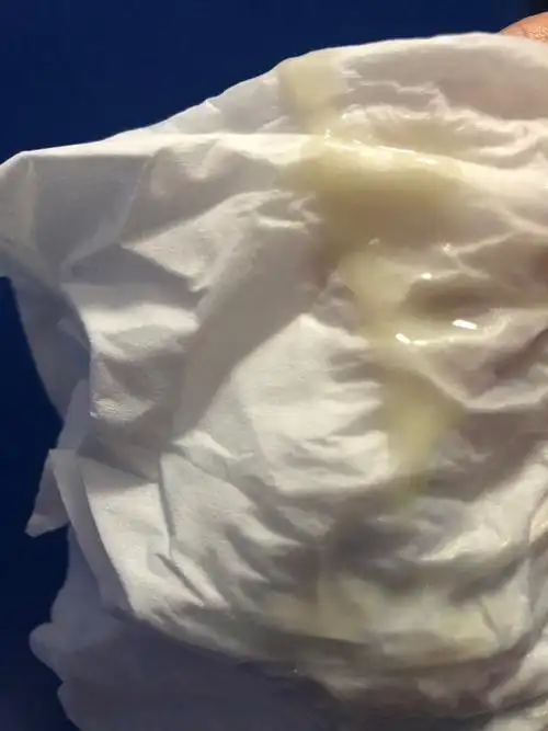 有哪位怀孕出现这种白带?还是妇科病