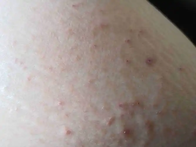 请问一下上周开始皮肤莫名的干痒,没注意,后来总是抓就这样了,是什么