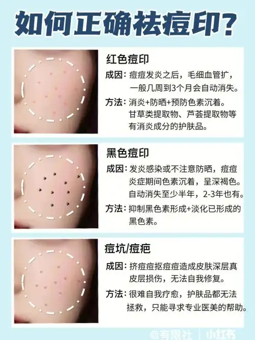 想要去痘印还不简单,首先找清楚自己是哪种痘印,对症下药.