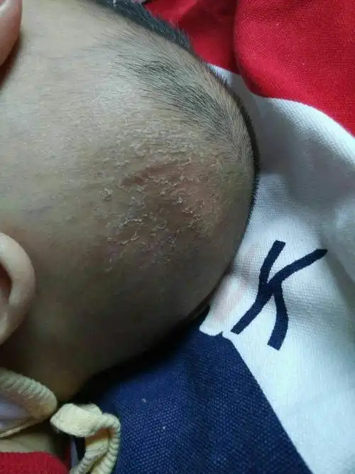 六个半月宝宝头上是怎么回事?