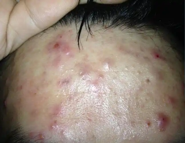 好像是毛囊发炎,怎么办,是吃什么药,还是买抹的药膏? 求药品!