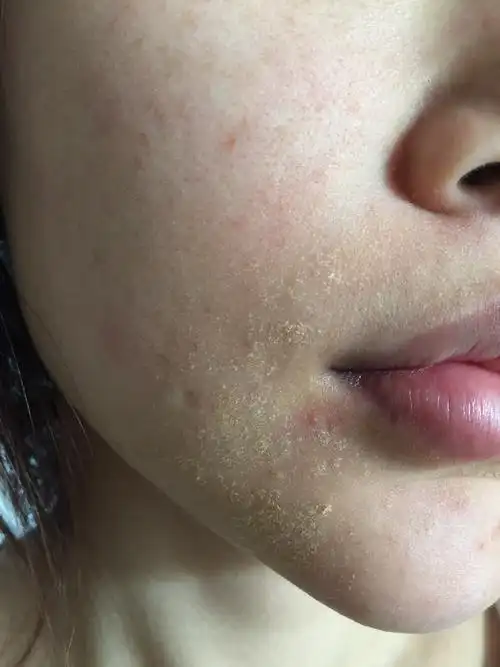 感觉经期前加重.曾经用过激素类药物.去就诊过说是脂溢性皮炎.