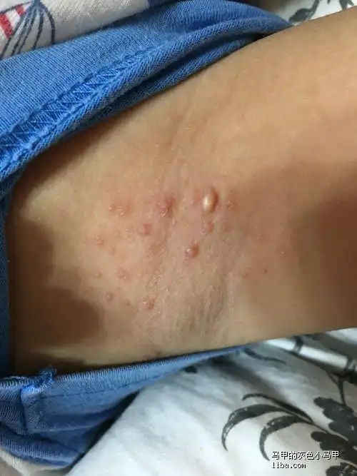 小孩腋下长这个是什么