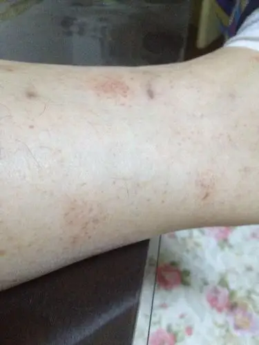 内科 免疫科 红斑狼疮 → 小腿出现一块一块的红斑请医生看看是什么情