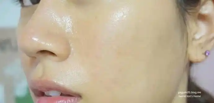 夏季皮肤油腻易长痘痘油性皮肤5大管理法来帮你