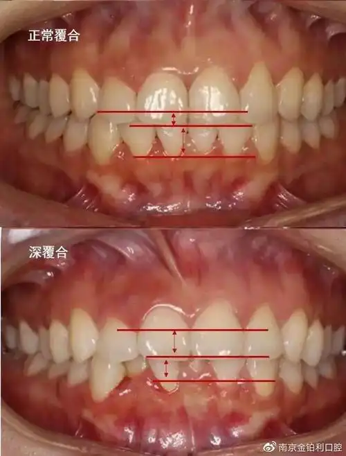 又叫做颌关系,正常的咬合应该是上排的牙窝,对准下排的牙尖,上排牙齿