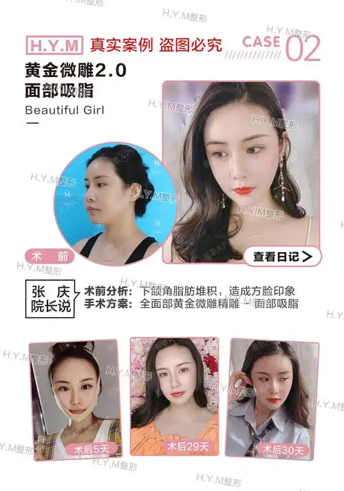 皮肤会变得松弛吗?7715面部吸_圈子-新氧美容整形