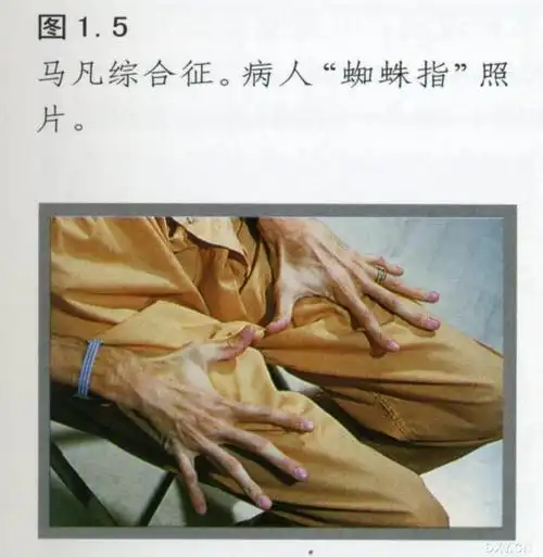 马凡氏综合征图示