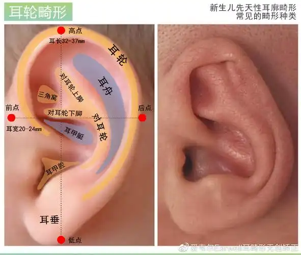 2,耳轮缘不卷曲1,耳轮粘连,扁平或消失耳轮畸形:1,耳廓上部下垂遮盖对