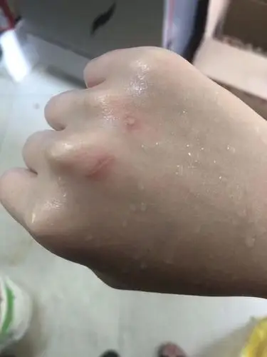 手上有小伤口 一直要泡水 能涂什么药好的快么