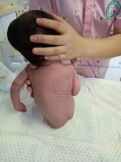 腭弓高   根据患儿的特殊面容,我们考虑患儿不排除马凡氏综合征