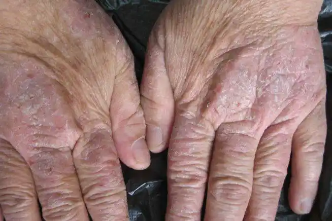 手上长手癣图片