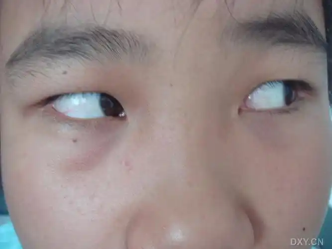 【眼外伤讨论】儿童突发性动眼神经麻痹