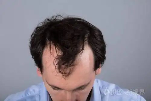 一个男人的头有脱发症状的闭合