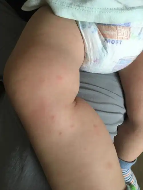 副主任医师刘维民回答宝宝荨麻疹的问题