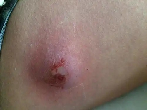 前几天腿根部不知道是疖子还是蚊子咬的很痒手抓会痛,整个大腿部都