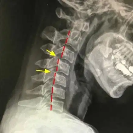 广州白领坐过山车扭了脖子,专家:颈椎病人群慎玩,严重可致瘫